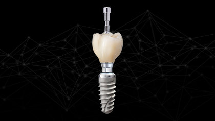 5 Ways to Achieve Accurate Fit for Screw-Retained Crowns image