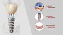 5 Ways to Expand Implant Services in Your Dental Practice image